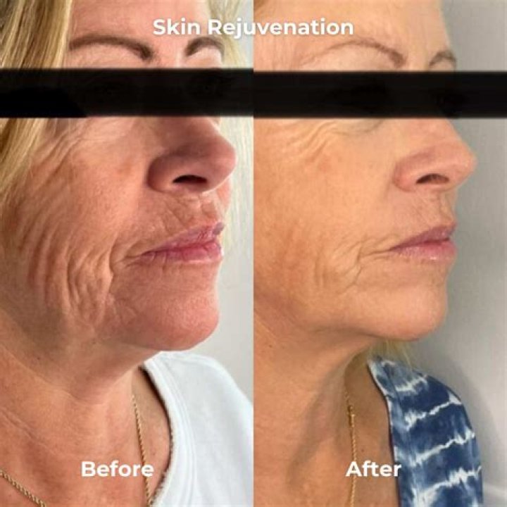 Microneedling Ruined My Skin: A Cautionary Tale