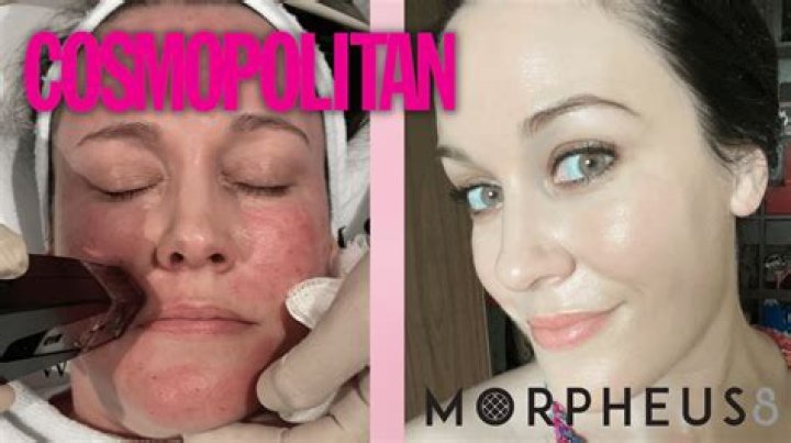 Morpheus8 Ruined My Skin: A Cautionary Tale