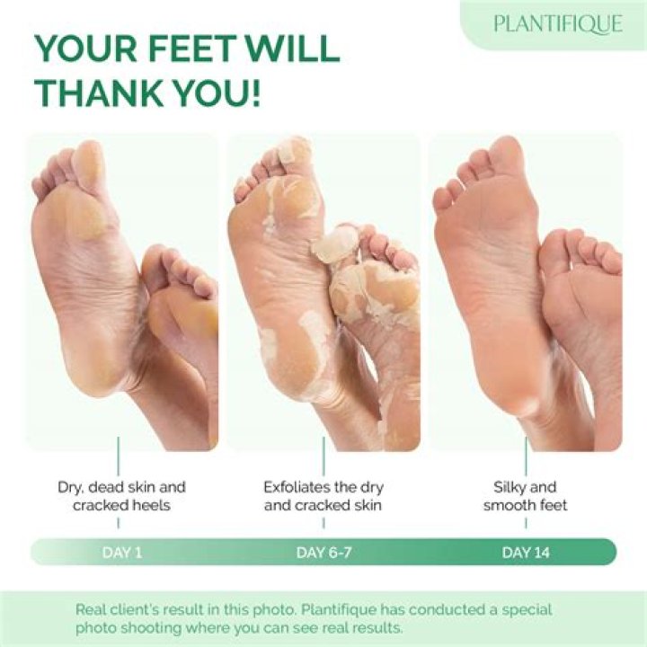 The Ultimate Guide to Achieving Perfect Feet with a Foot Peel