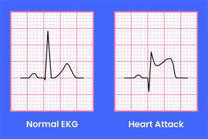 Understanding Bray Wyatt's Heart Attack: An In-Depth Exploration